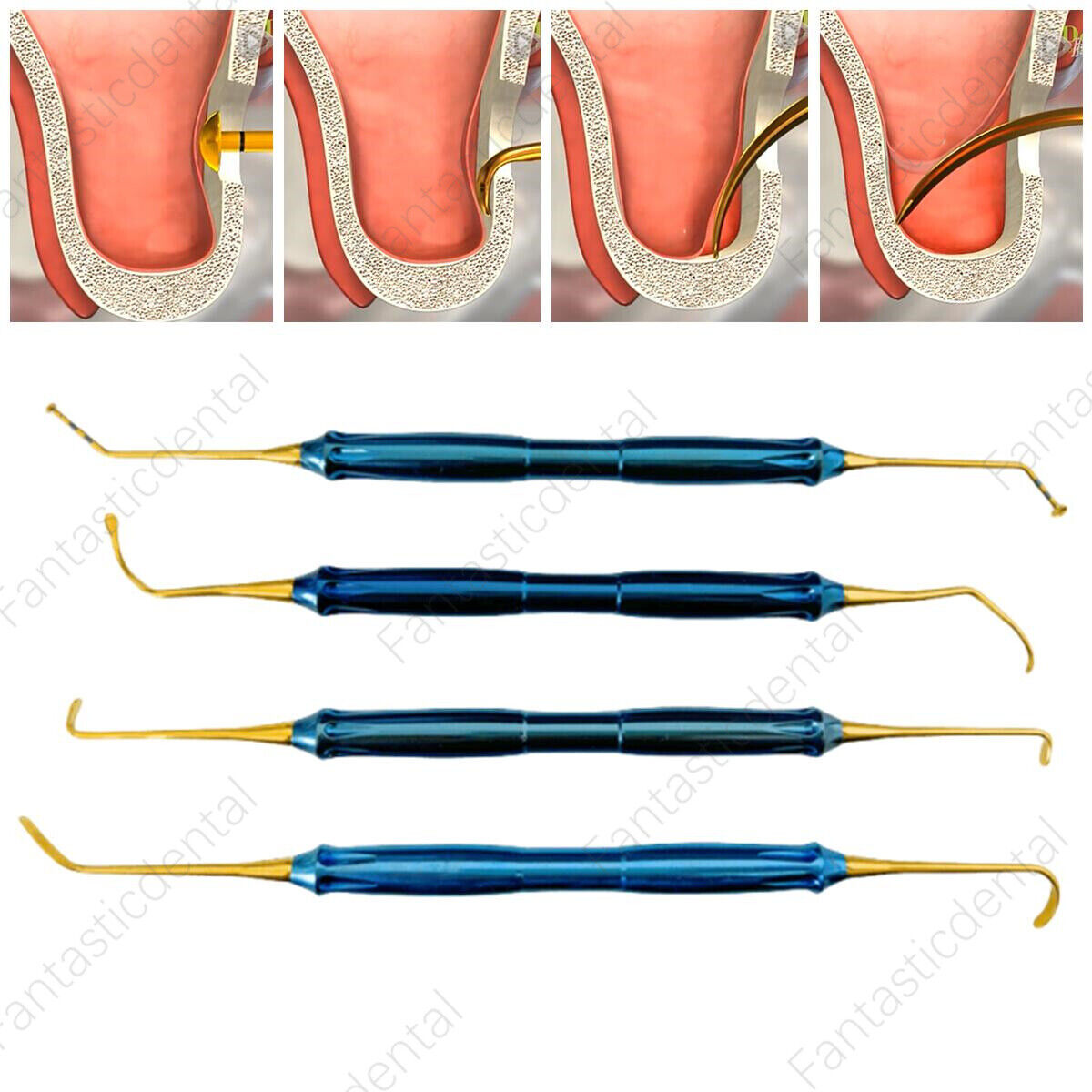 Dental Lift Handles DASK Sinus Tool Instruments 4Types Fits Den