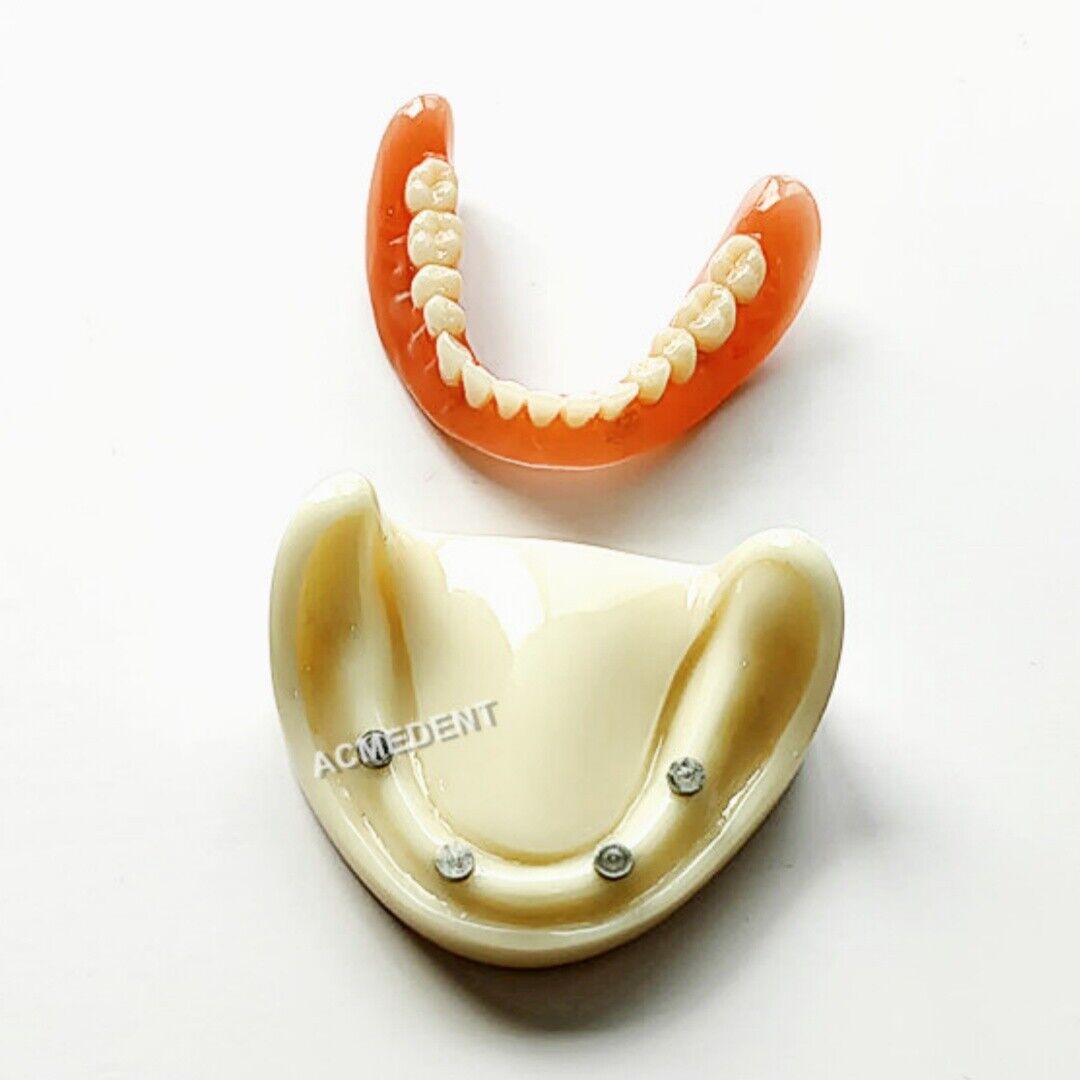 Dental Denture Model Overdenture Magnetic Attachment Mandibular Low False Teeth